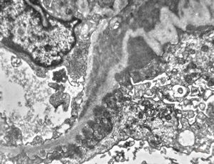 F,40y. | type III membranoproliferative glomerulonephritis